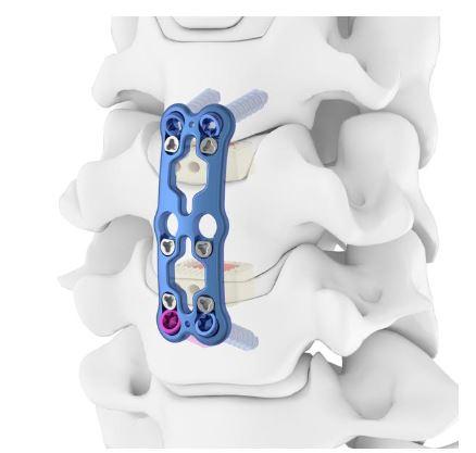 Передня шийна пластина ІІІ, ( Double Medical Technology Inc.)